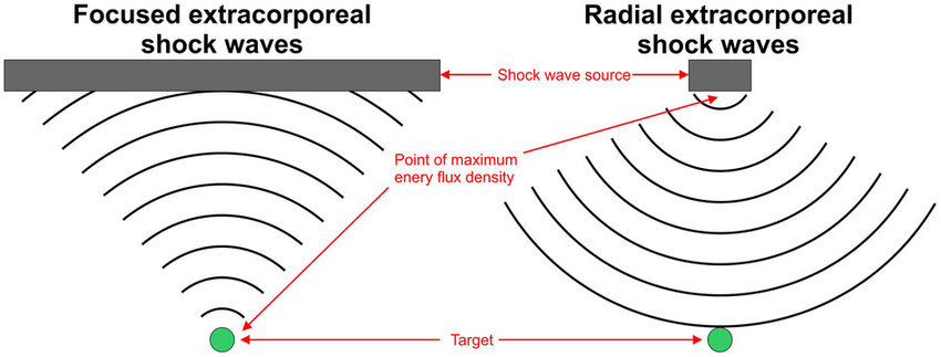 ภาพแสดง : การกระจายคลื่นของ Focus shockwave (ซ้าย) และ Radial shockeave (ขวา